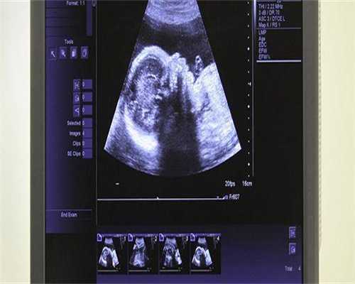 哪里做代孕好,卵巢粘连怎么治疗能生孩子吗?需要注意什么!