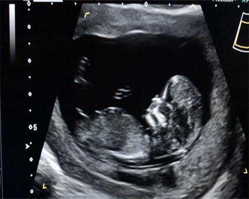 为什么来月经第一天就有宫缩的痛（来月经肚子疼怎么办）