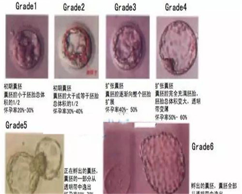 三代试管包男孩吗,卵巢囊肿能要孩子吗卵巢囊肿怎么要孩子
